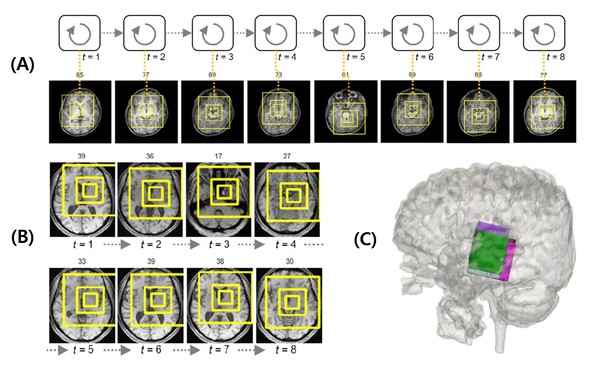 ▲A. 세브란스병원 ASD 환자의 MRI 빅데이터에서 인공지능 모델이 자폐 중증도와 관련된 뇌 주요 부위들의 연관 관계를 찾아내는 모습B. 국제컨소시엄으로 구축된 1000여 건의 자폐증 환자 MRI 빅데이터에서 인공지능 모델이 자폐 중증도와 관련된 뇌 주요 부위들의 연관 관계를 찾아내는 모습C. A와 B의 주요 부위를 3차원으로 표현한 뇌 이미지