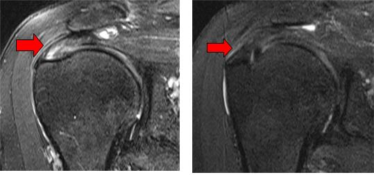 ▲왼쪽: 회전근개 부분 파열(화살표 부위) MRI 검사 장면   오른쪽: 회전근 개 부분 파열 부위에 아텔로콜라겐 주사 6개월 후 시행한 MRI 검사 결과에서 회전근 개 파열 부위가 회복된 것으로 나타났다.(화살표 부위)
